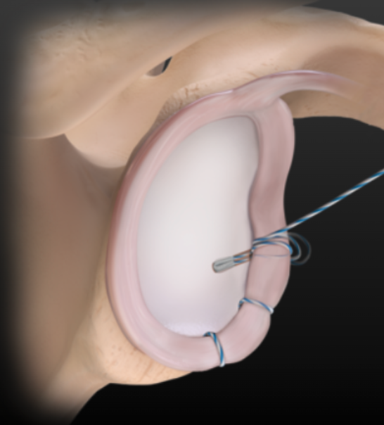 Outcome of Glenoid Labral Repair Using All Suture Anchors
